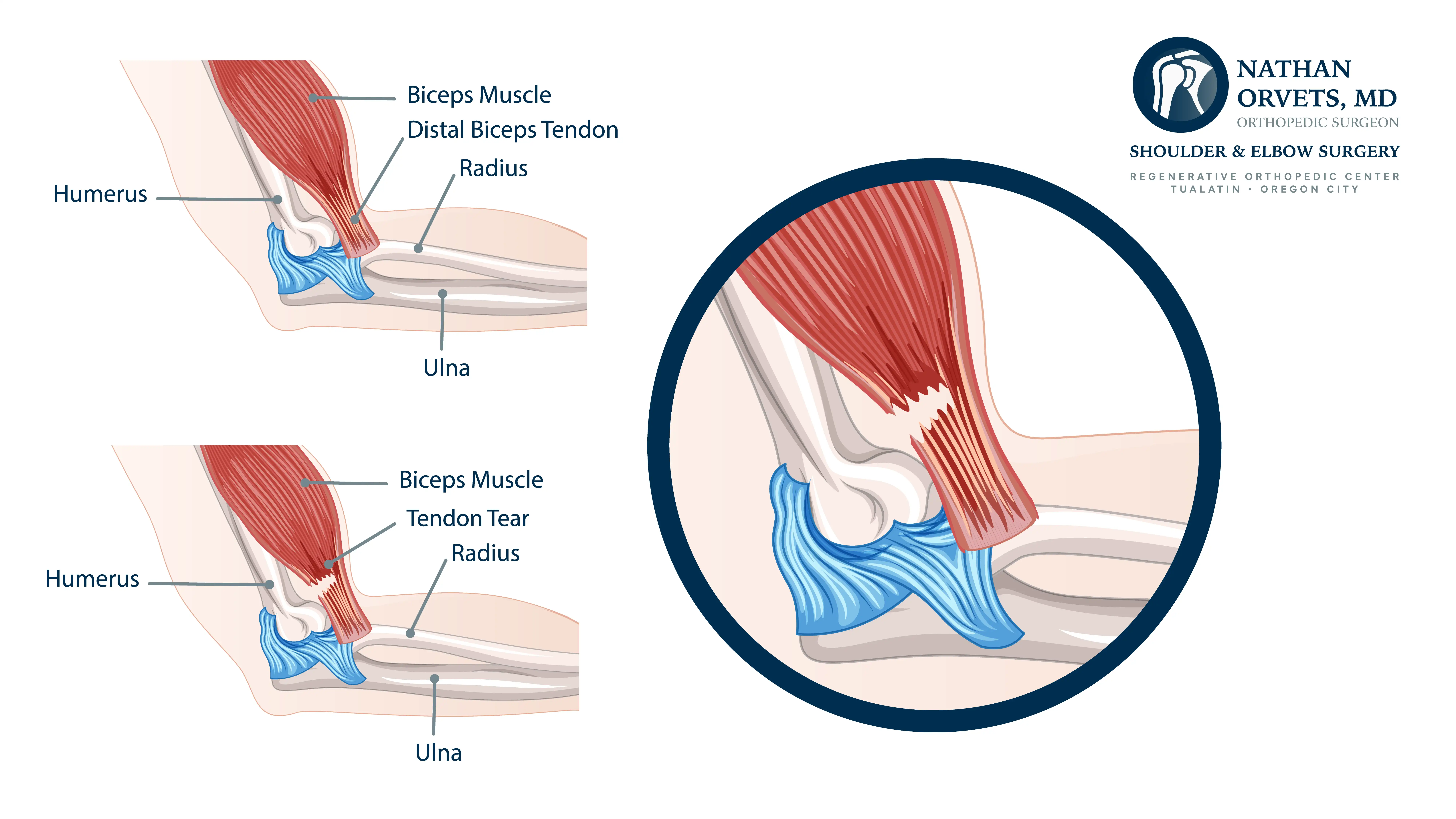 Anatomical Grpahic of Bicep Tendon Tear