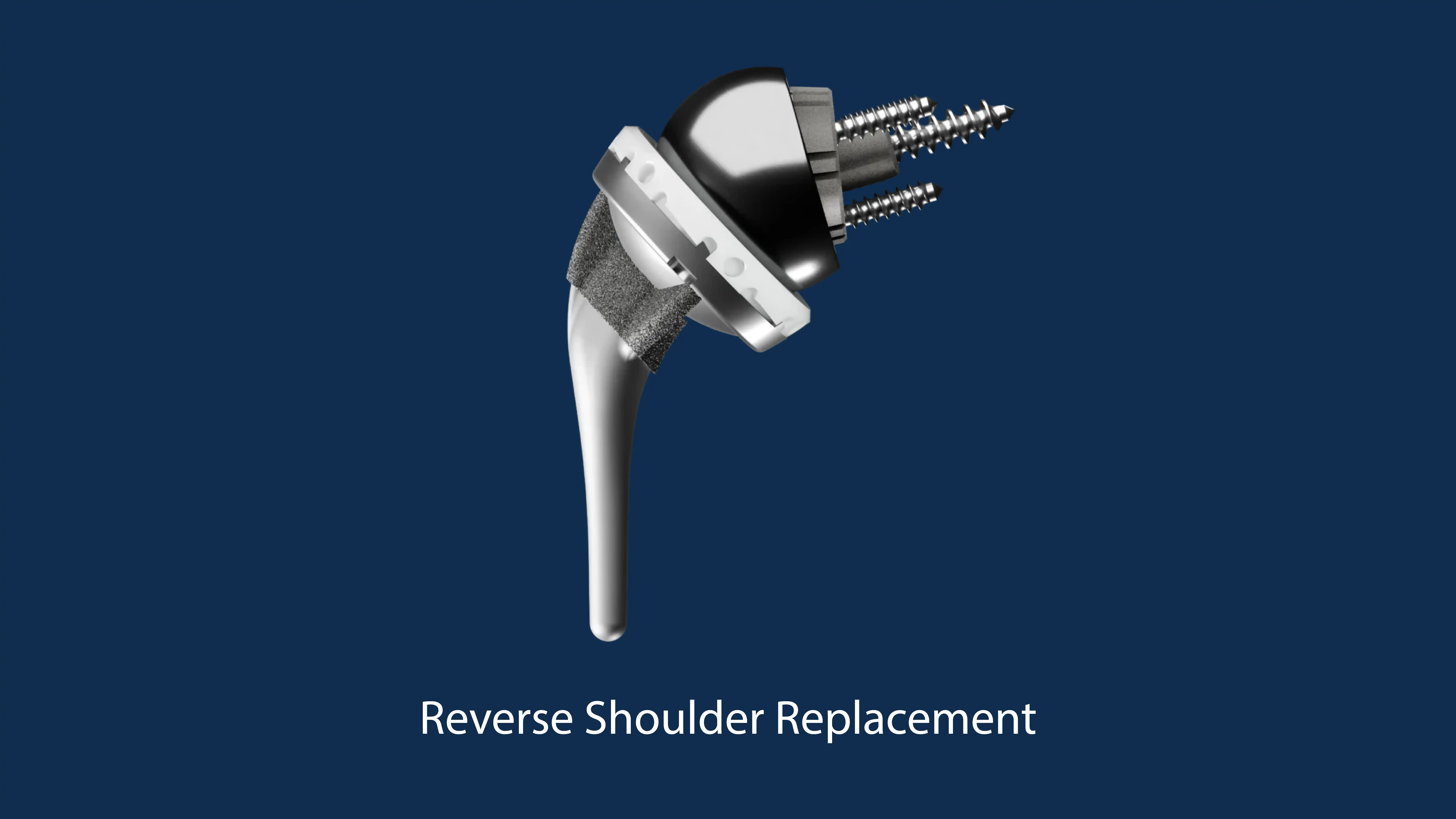 Shoulder Innovations Reverse Total Shoulder Implant