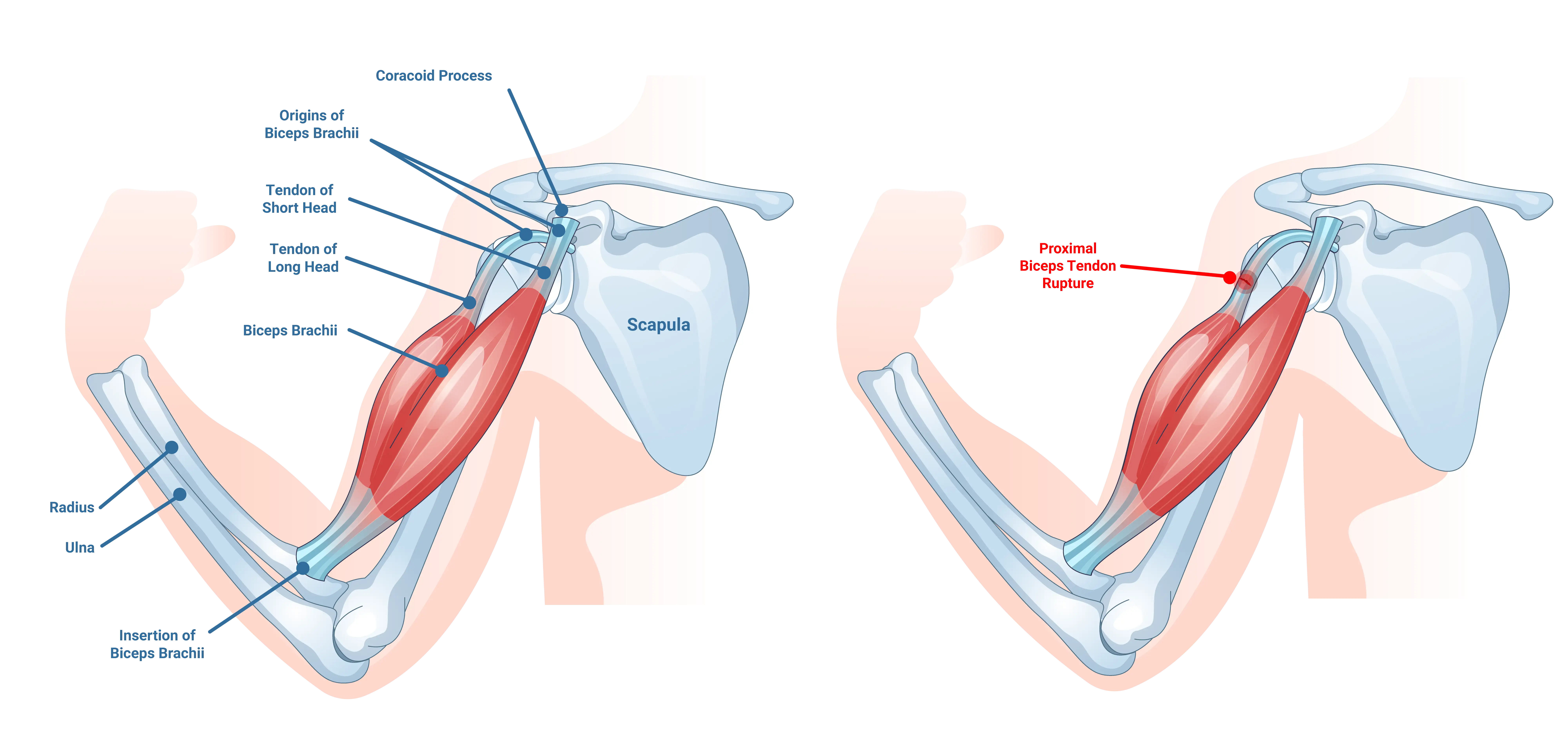 Proximal Bicep Tendon Injuries Anatomical Graphic