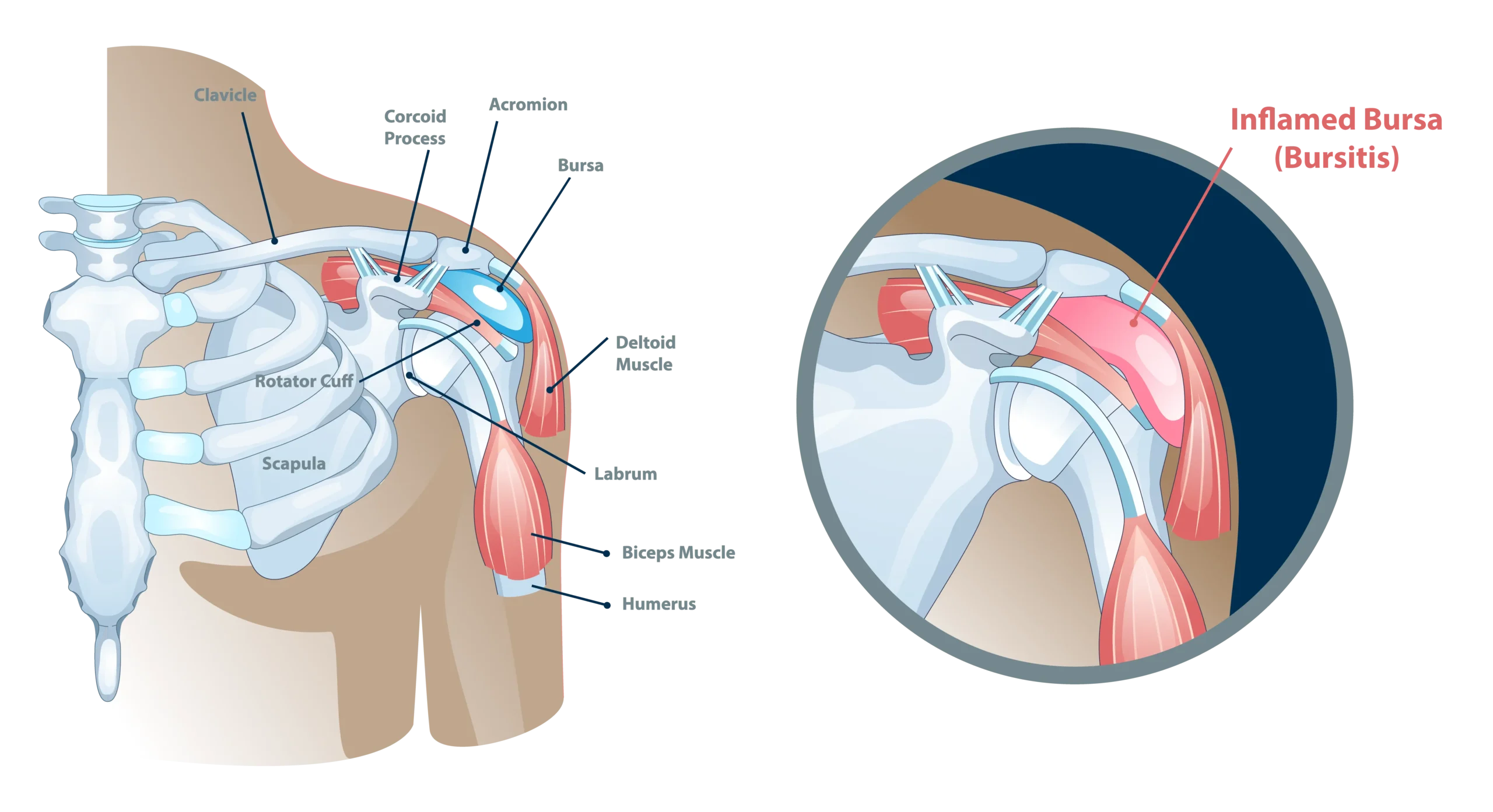 Shoulder Bursitis
