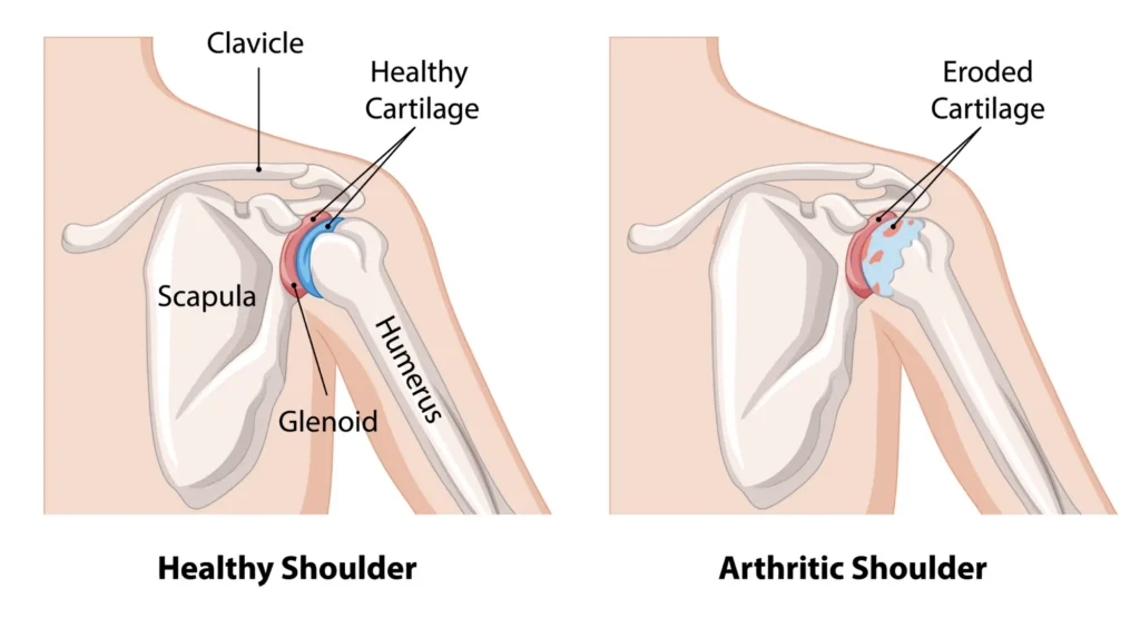 Diagram of a healthy shoulder vs an arthritic shoulder