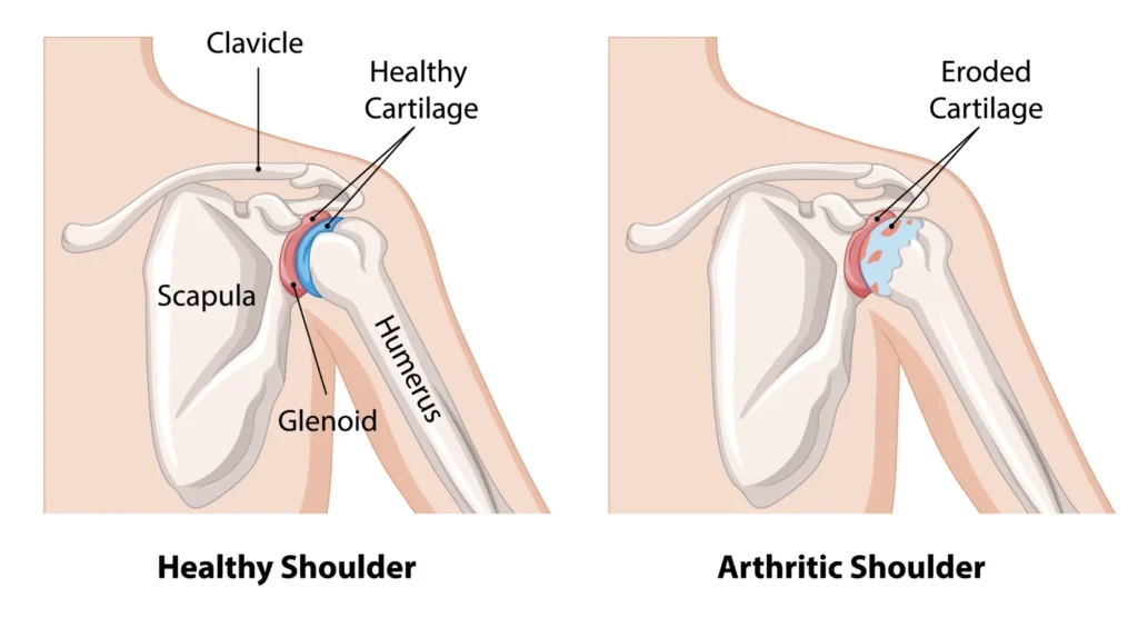 Diagram comparing a healthy shoulder vs an arthritic shoulder
