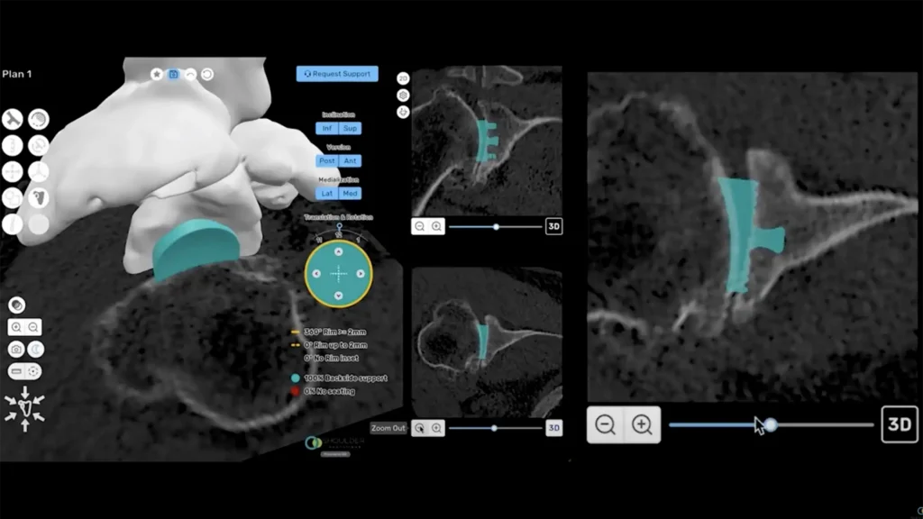 ProVoyance shoulder planning software
