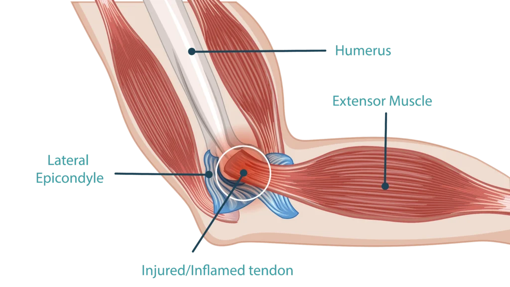 anatomy of a person experiencing tennis elbow