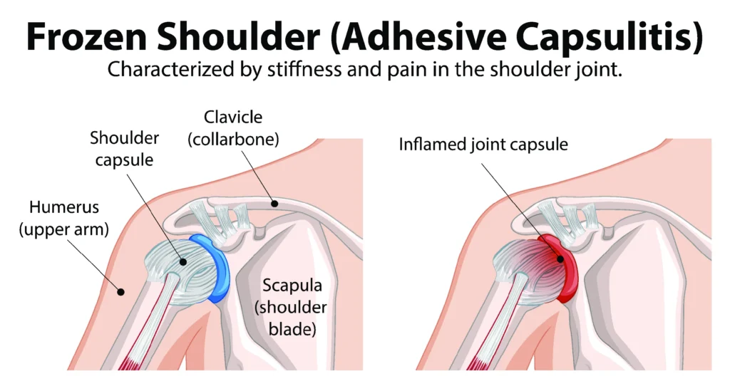 frozen shoulder diagram internal frozen shoulder diagram with labels