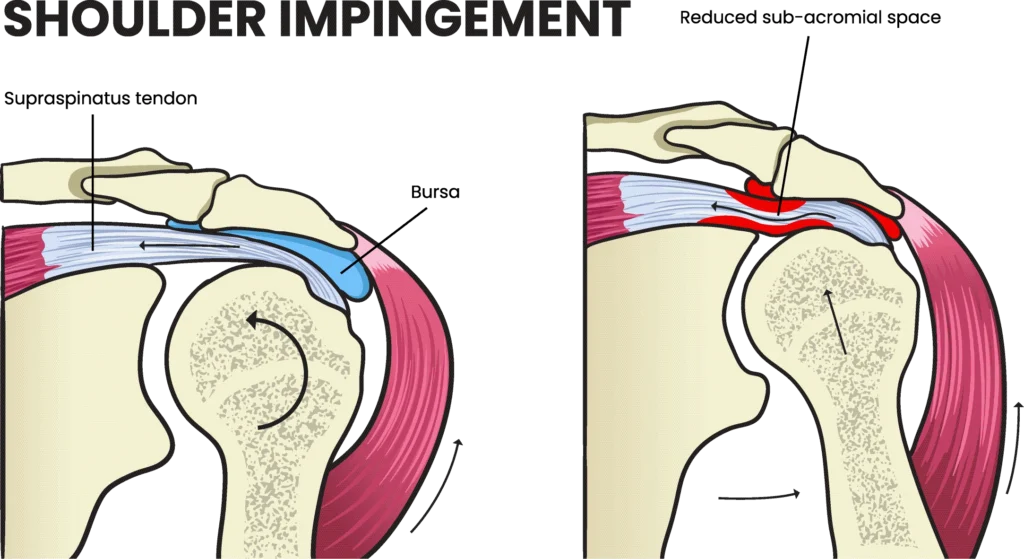 shoulder impingement diagram showing shoulder impingement, specifically in the reduced sub-acromial space.