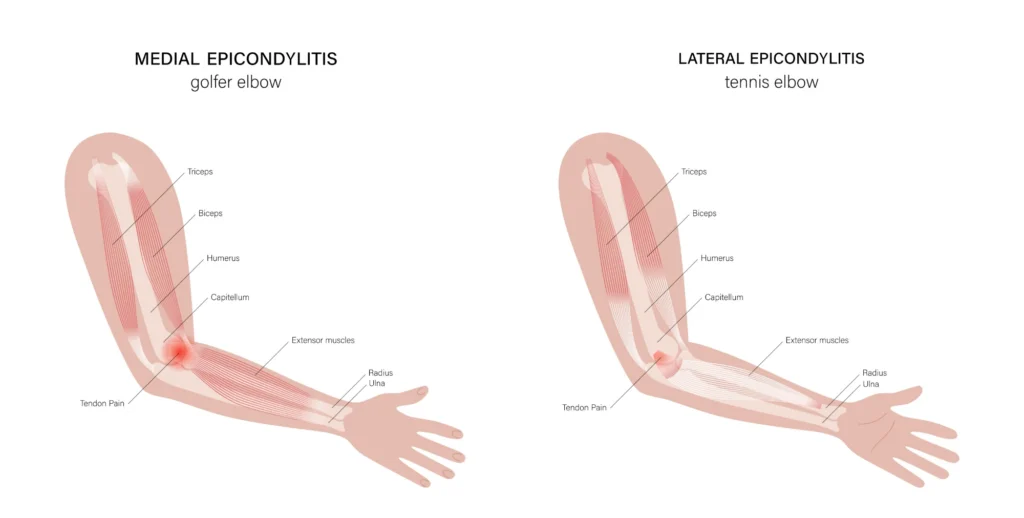 lateral vs. medial epicondylitis diagram showing the differences between lateral and medial epicondylitis.