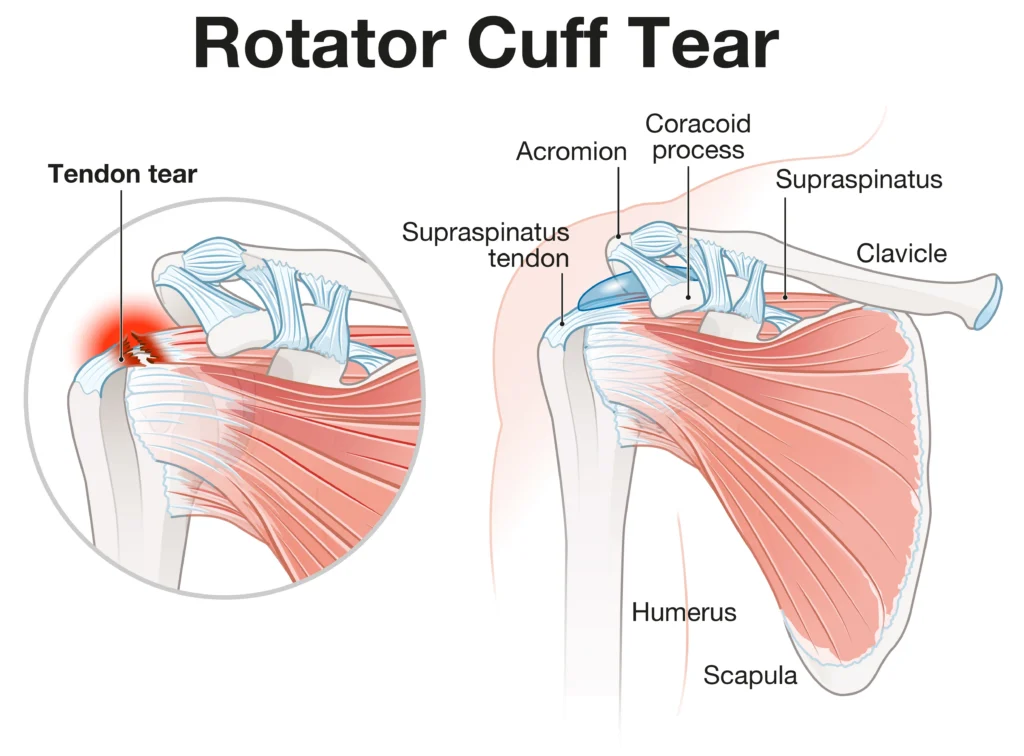 rotator cuff tear rotator cuff tear diagram showing the tendon tear in comparison to the healthy shoulder anatomy.