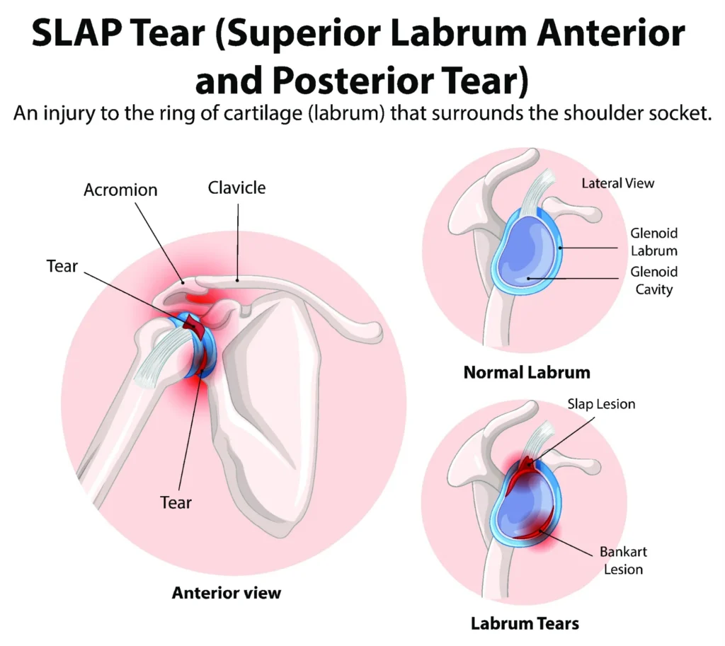 SLAP tear diagram comparing the healthy shoulder to a labrum tear in both lateral and anterior viewpoints.