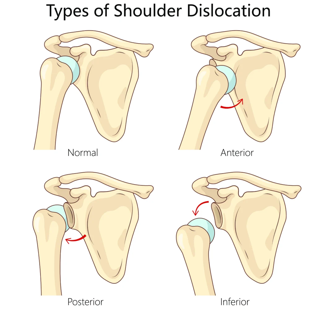 Different types of shoulder dislocations.
