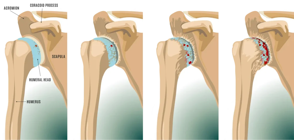 Progression through shoulder arthritis.