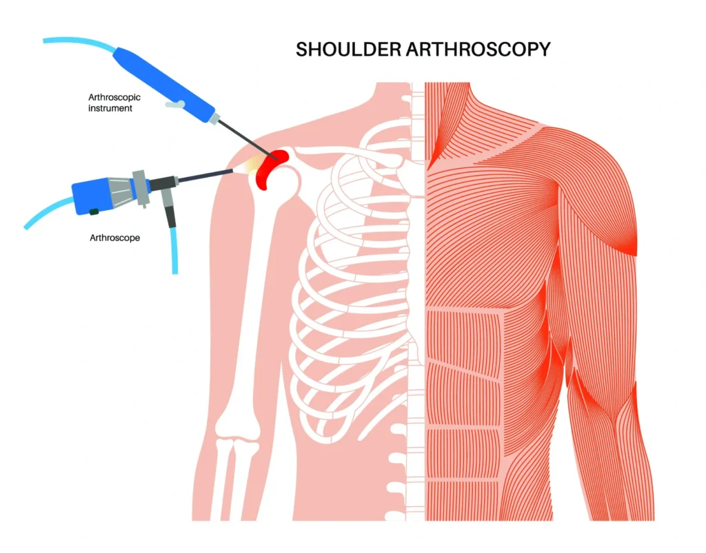 shoulder arthroscopy diagram 