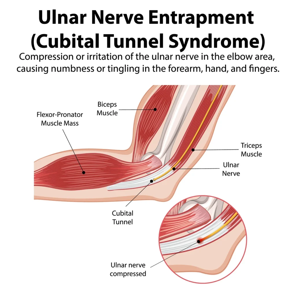 ulnar nerve entrapment diagram.